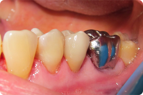 Porcelain crowns, after