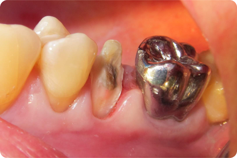 Porcelain crowns, before