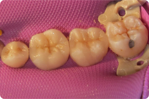 Porcelain onlays, after