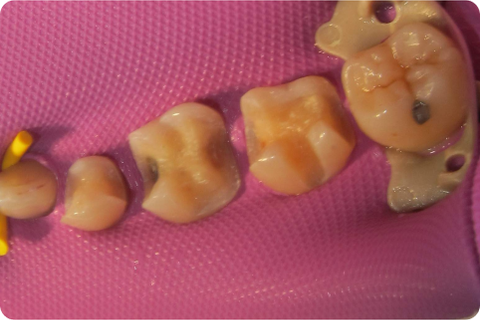 Porcelain onlays, before
