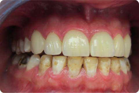 Porcelain veneers, after