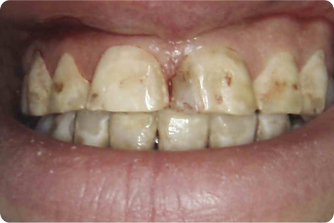 Porcelain veneers, before