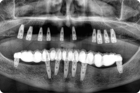 Implants and grafts, panoramic radiograph