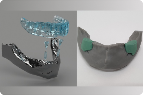 Implants and grafts, digital planning