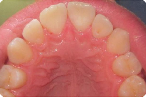Prophylaxis, after