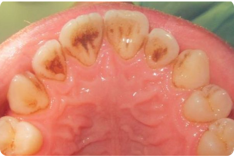 Prophylaxis, before