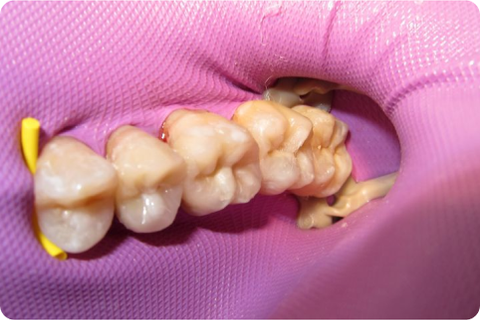 Biomimetic dentistry, after