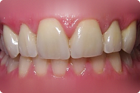 Complete smile, after