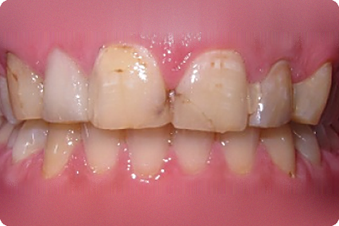 Complete smile, before